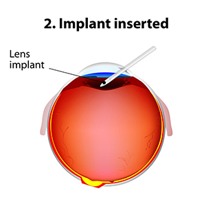 cataract surgery 02